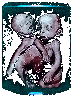 Pickled Punks, Circus Freak Shows, Circus Sideshow